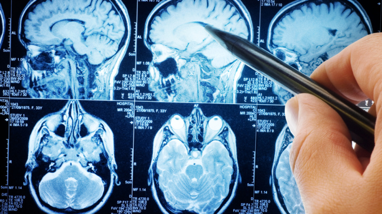 What You Need to Know About Brain Cancer